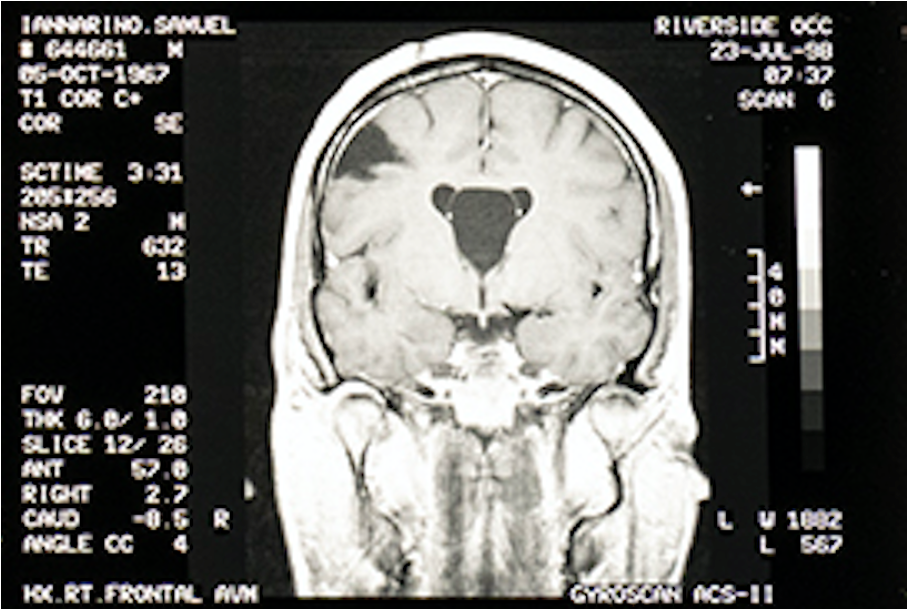 Iannarino brain scan