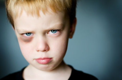 alt text for the image of a kid with a black eye